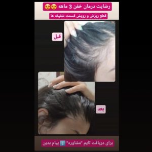نگذارید با ریزش مو زیبایی تان رو از دست بدین.