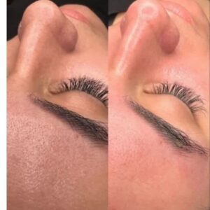پاکسازی(فیشیال)تخصصی پوست