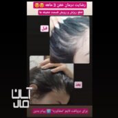 نگذارید با ریزش مو زیبایی تان رو از دست بدین.